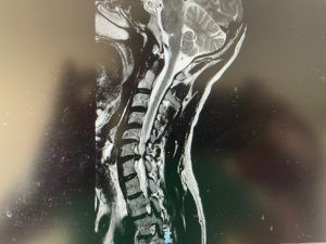 RM cervical 300x225 1