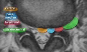 tipos de hernias discales 300x182 1