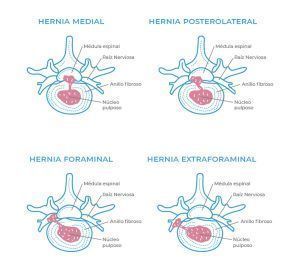 tipos hernias discales 300x269 1